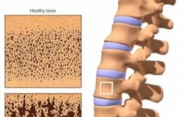 Fractura Vertebral Patológica: Una leve introducción a la osteoporosis